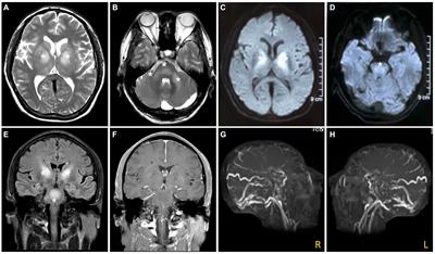 Dural arteriovenous fistula and sinus thrombosis presenting as parkinsonism and dementia: a case report with literature review